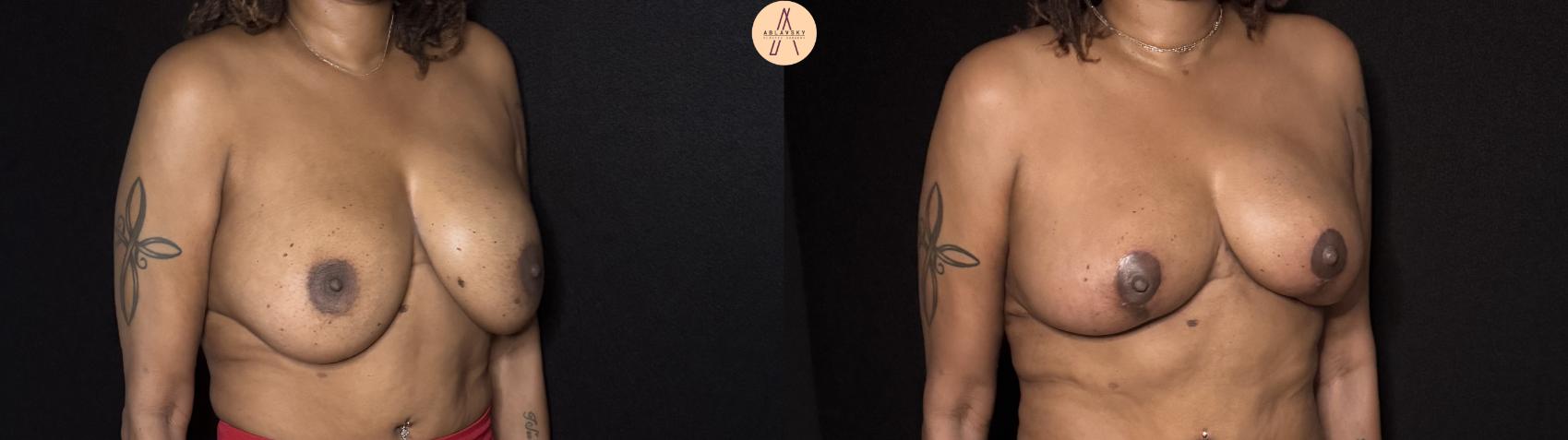 Before & After Implant removal with breast lift and auto augmentation Case 505 Right Oblique View in San Antonio, Texas
