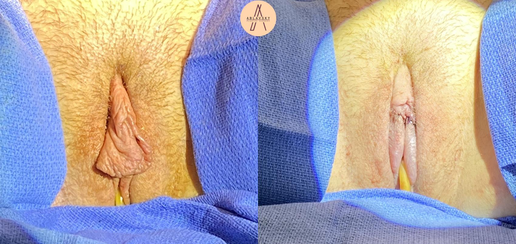 Before & After Labiaplasty Case 173 Front View in San Antonio, Texas