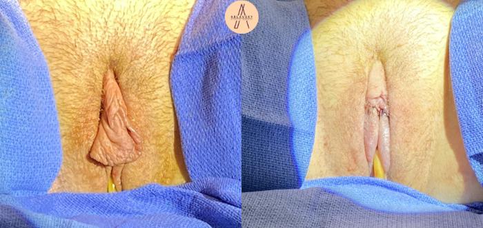 Before & After Labiaplasty Case 173 Front View in San Antonio, Texas