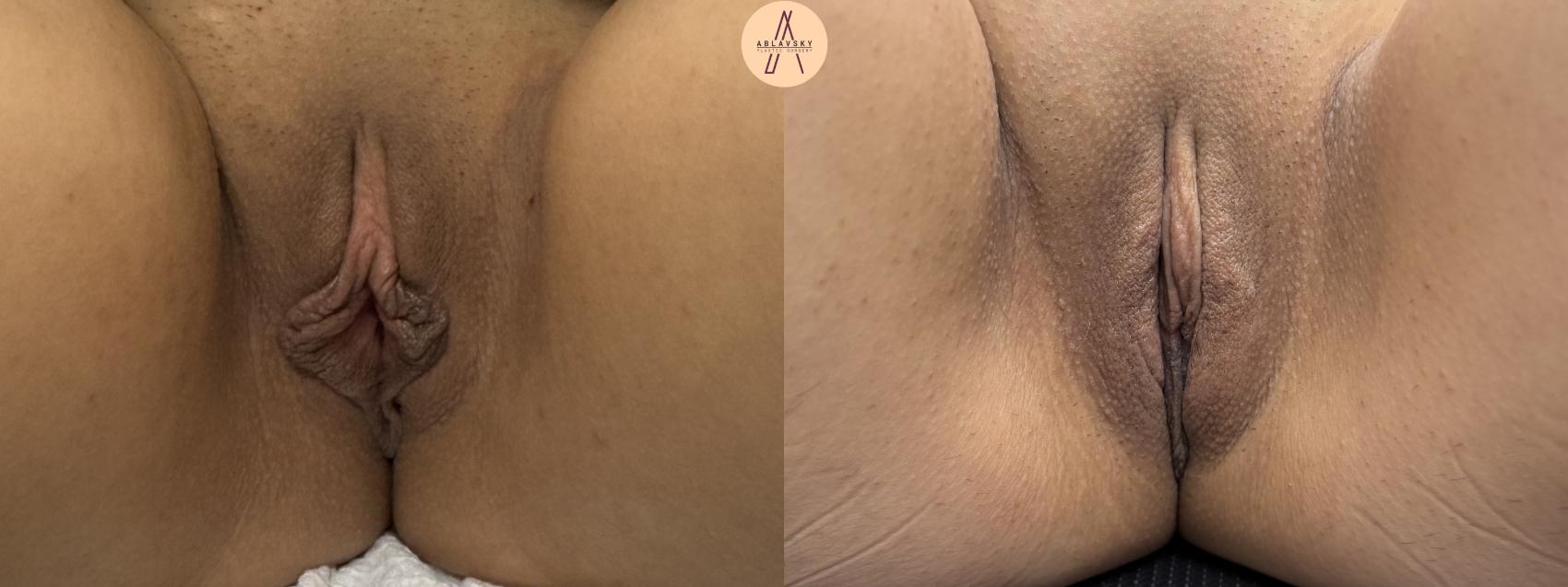 Before & After Labiaplasty Case 412 Front View in San Antonio, Texas