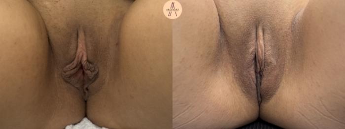 Before & After Labiaplasty Case 412 Front View in San Antonio, Texas