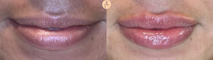 Before & After Lip Filler Case 407 Soft Smile View in San Antonio, Texas