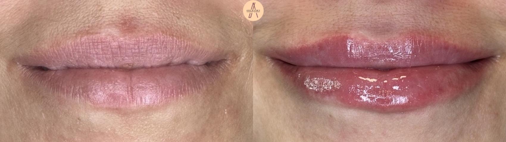 Before & After Lip Filler Case 408 Smile View in San Antonio, Texas