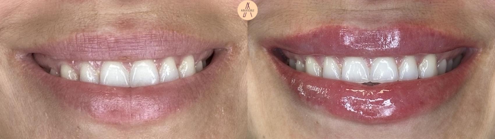 Before & After Lip Filler Case 408 Soft Smile View in San Antonio, Texas