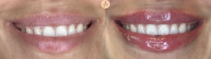 Before & After Lip Filler Case 408 Soft Smile View in San Antonio, Texas