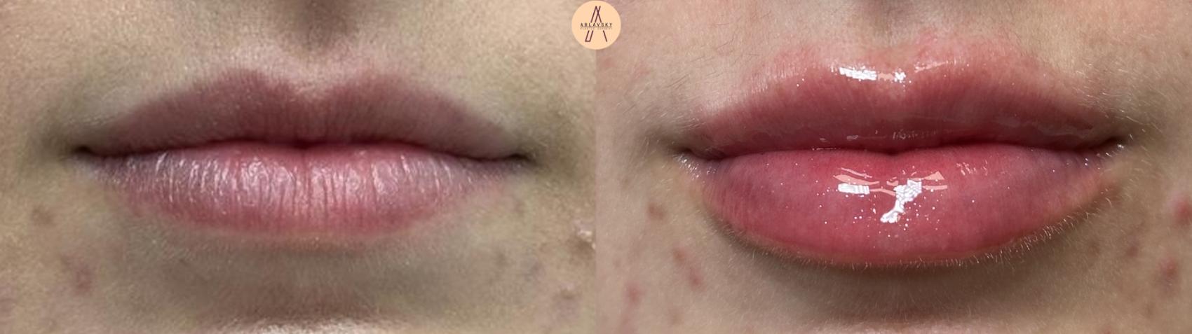 Before & After Lip Filler Case 411 Relaxed  View in San Antonio, Texas