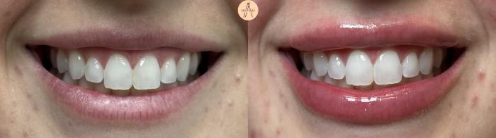 Before & After Lip Filler Case 411 Smile View in San Antonio, Texas