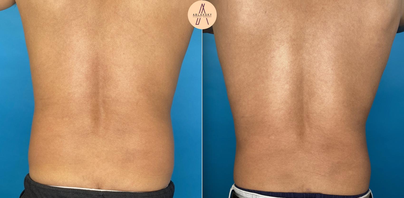Before & After Liposuction Case 1 Back View in San Antonio, Texas