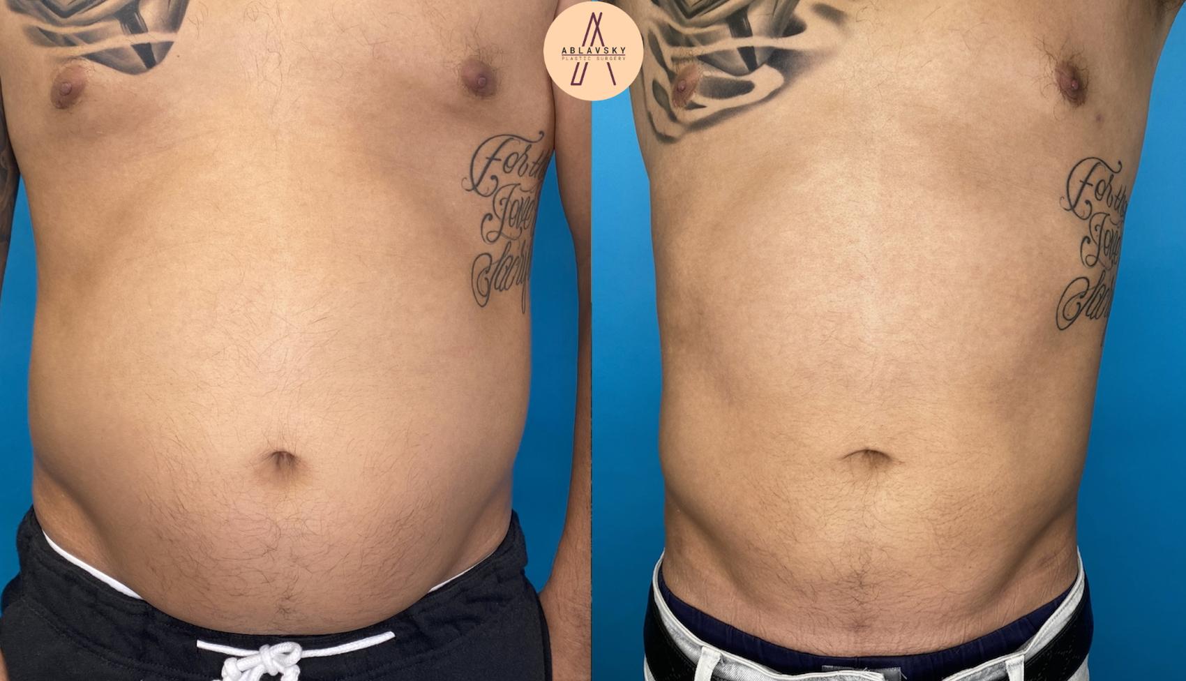 Before & After Liposuction Case 1 Front View in San Antonio, Texas