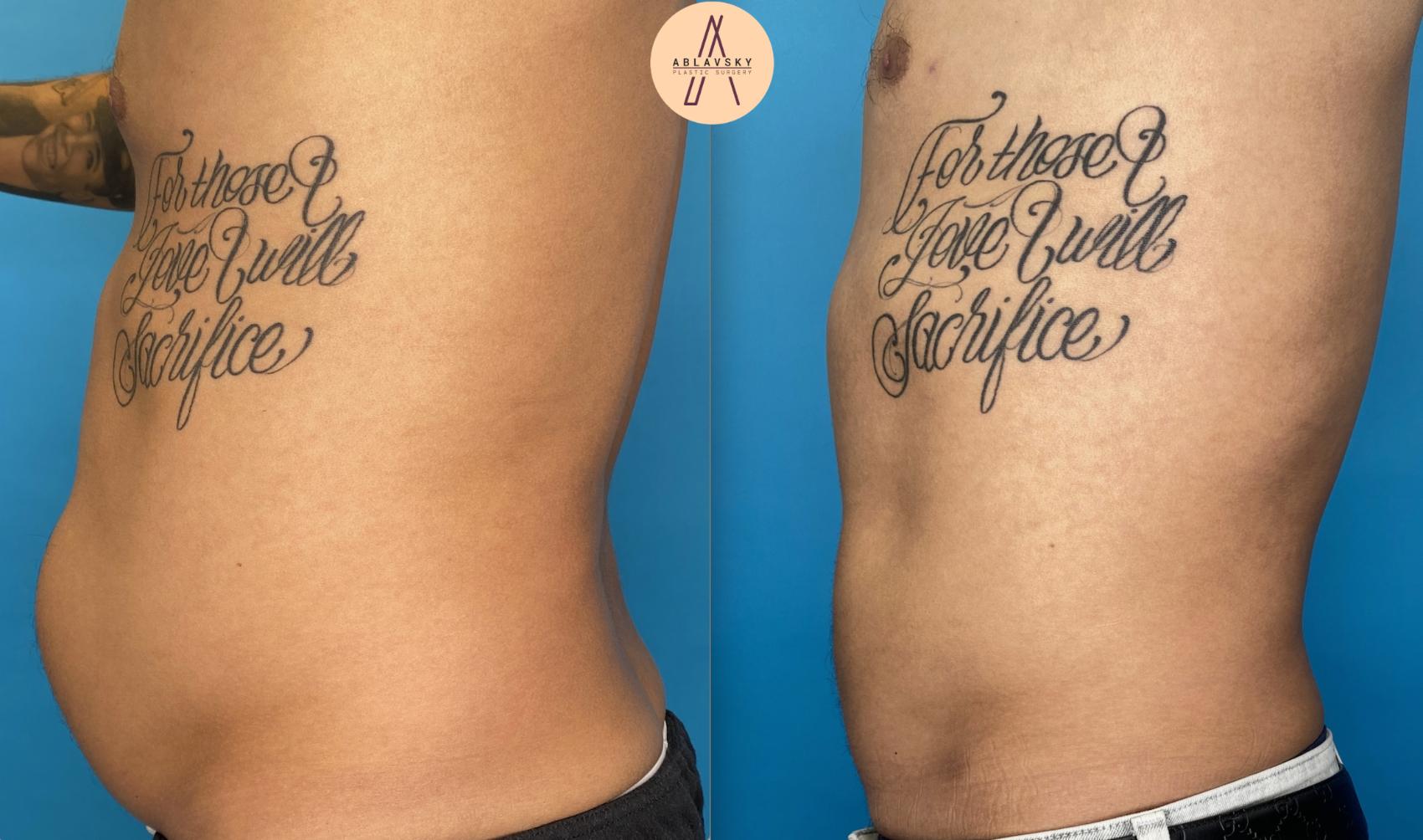 Before & After Liposuction Case 1 Left Side View in San Antonio, Texas