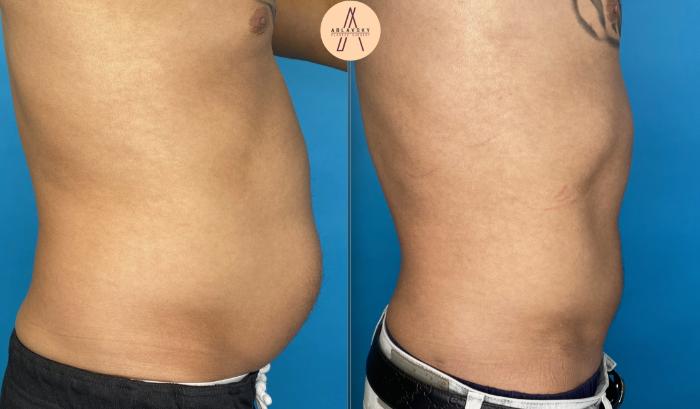 Before & After Liposuction Case 1 Right Side View in San Antonio, Texas