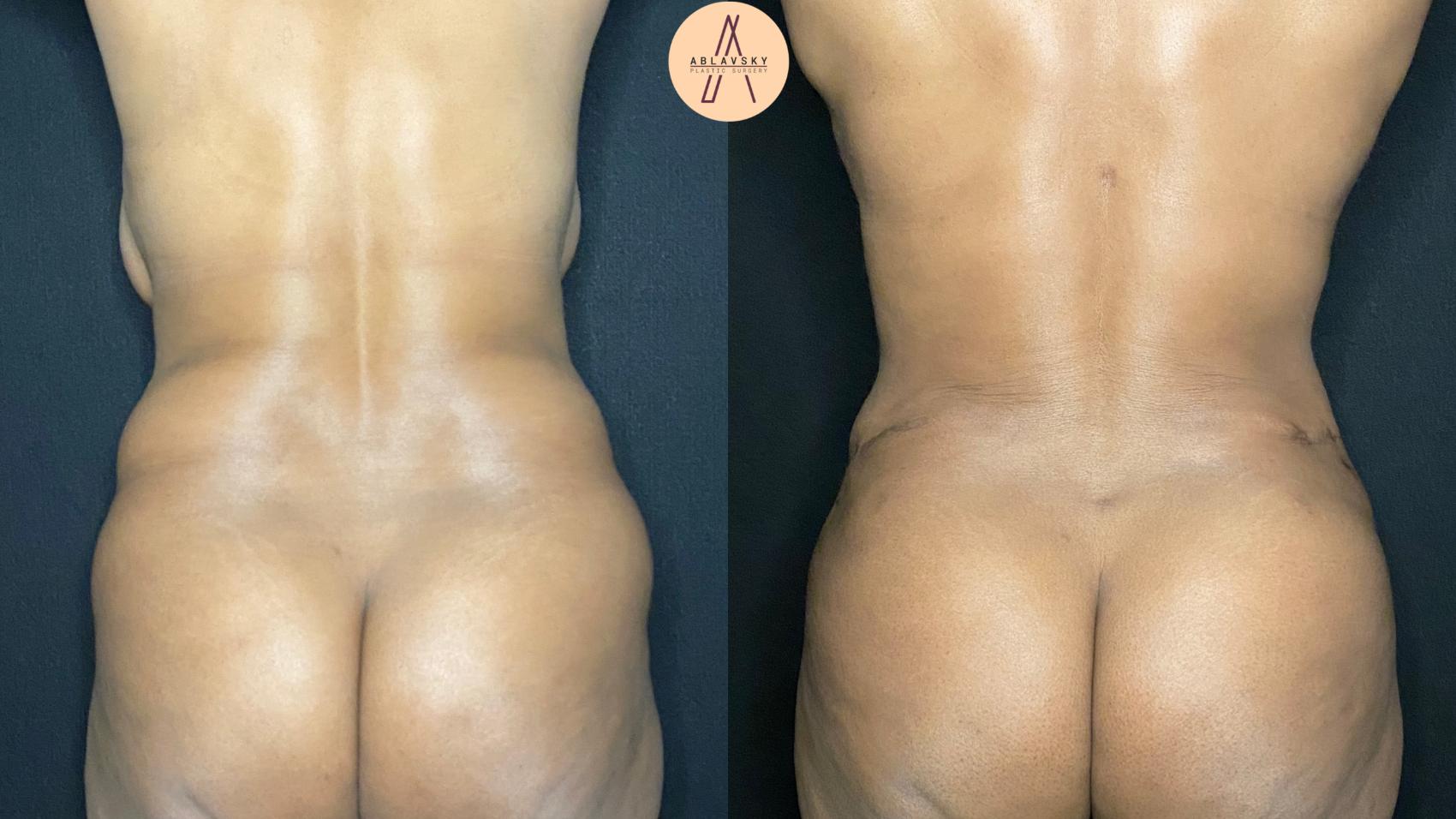 Before & After Liposuction Case 106 Back View in San Antonio, Texas