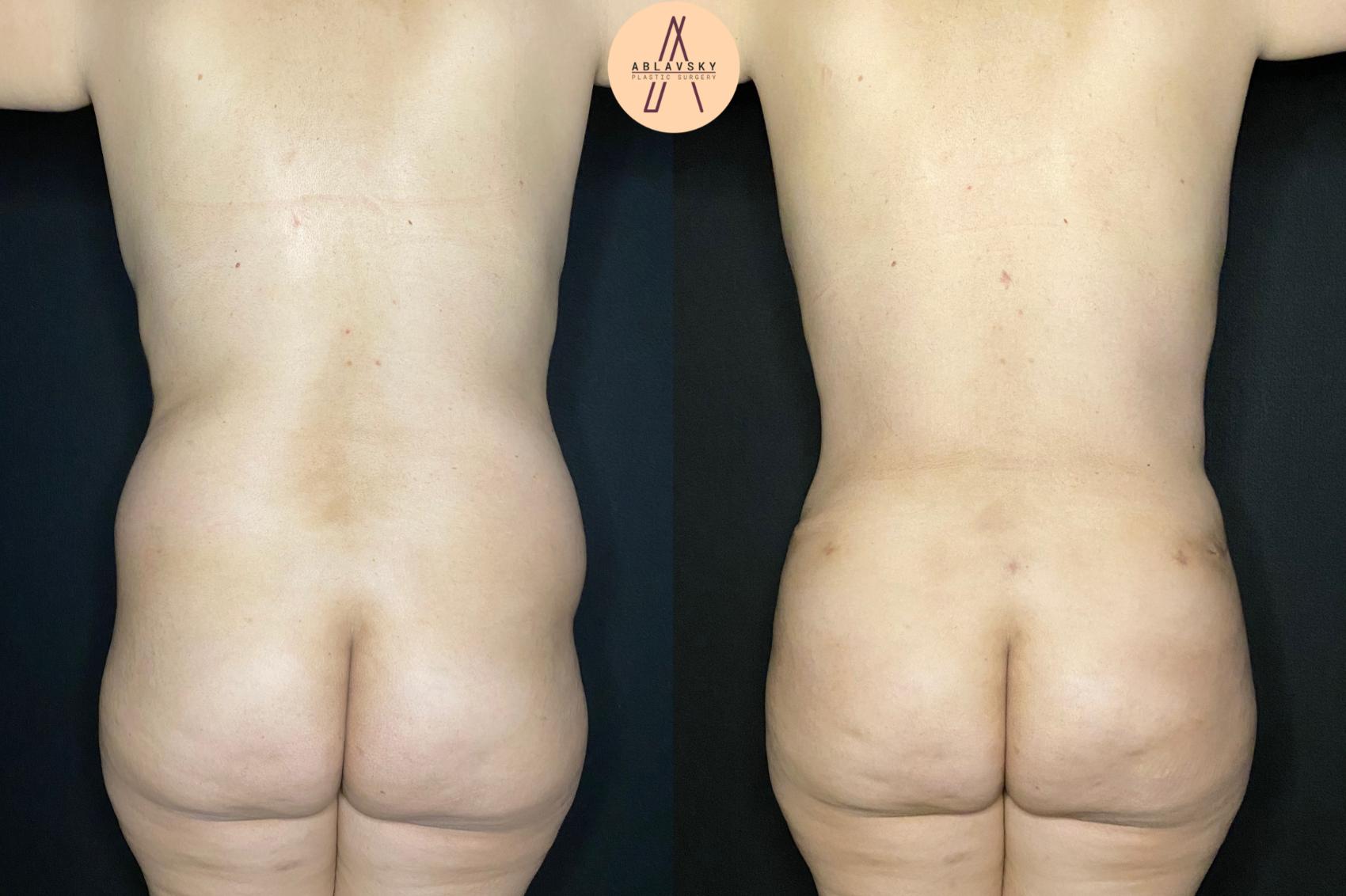 Before & After Liposuction Case 110 Back View in San Antonio, Texas
