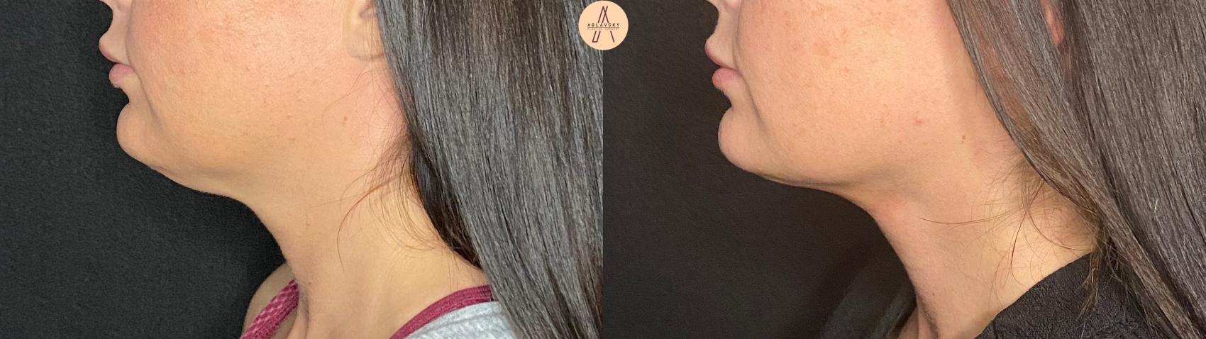 Before & After Submental Liposuction Case 113 Left Side View in San Antonio, Texas