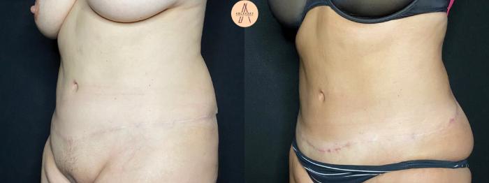 Before & After Liposuction Case 124 Left Oblique View in San Antonio, Texas