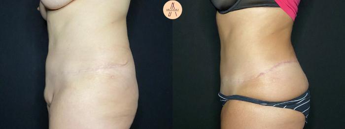 Before & After Liposuction Case 124 Left Side View in San Antonio, Texas