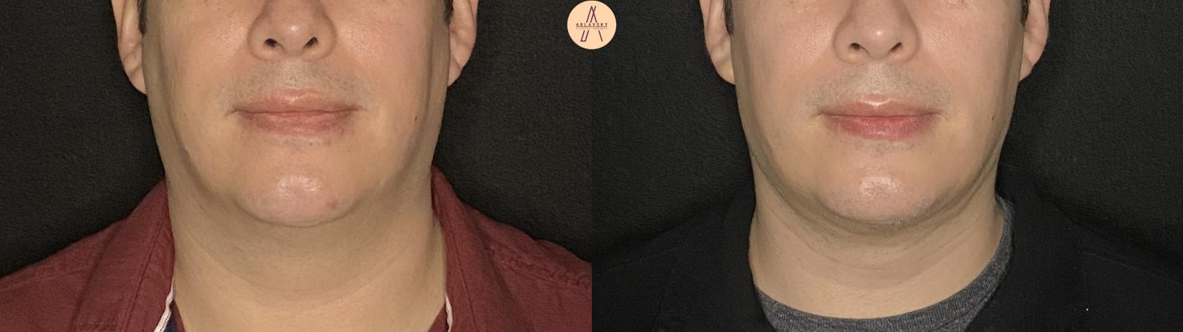 Before & After Liposuction Case 160 Front View in San Antonio, Texas