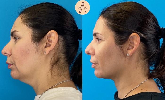 Before & After Liposuction Case 20 Left Side View in San Antonio, Texas