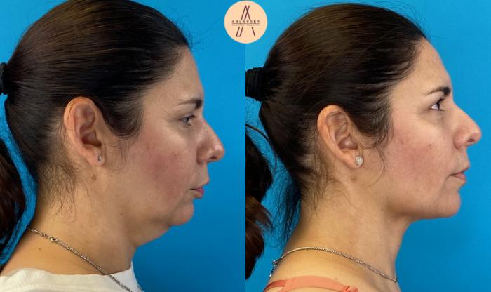 Before & After Liposuction Case 20 Right Side View in San Antonio, Texas