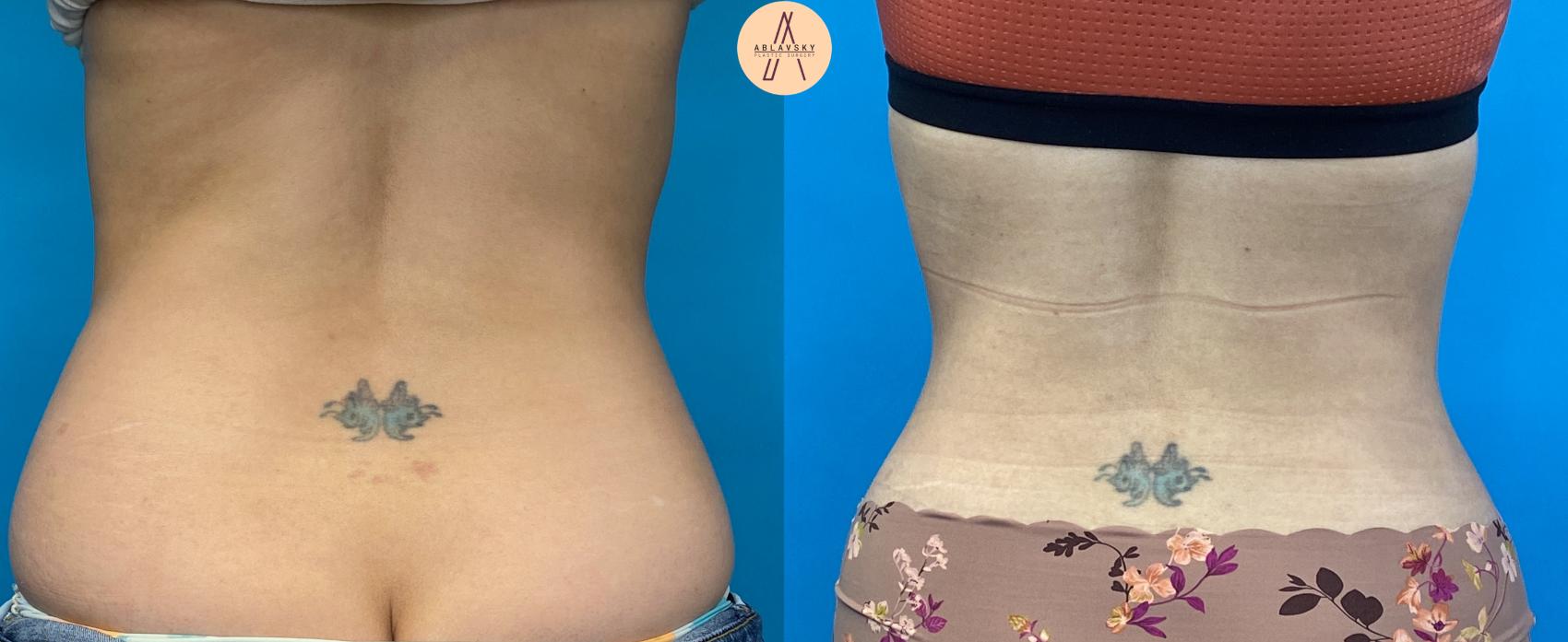 Before & After Liposuction Case 21 Back 2 View in San Antonio, Texas