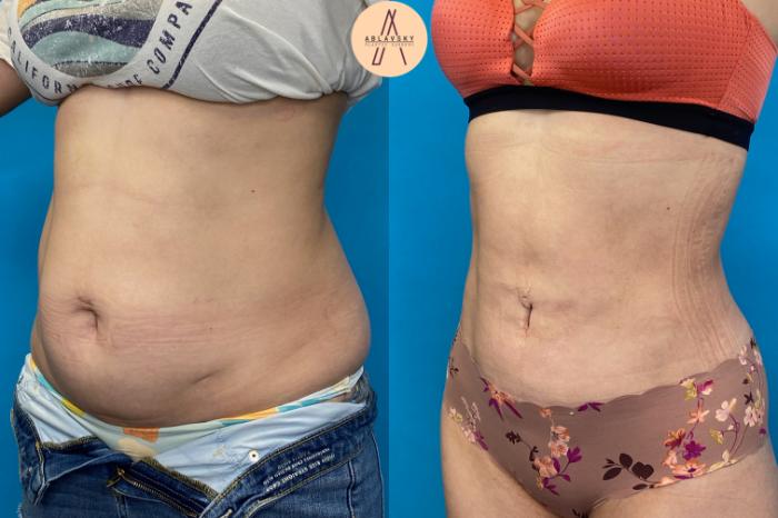 Before & After Liposuction Case 21 Left Oblique View in San Antonio, Texas