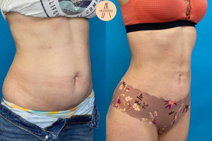 Before & After Liposuction Case 21 Right Oblique View in San Antonio, Texas