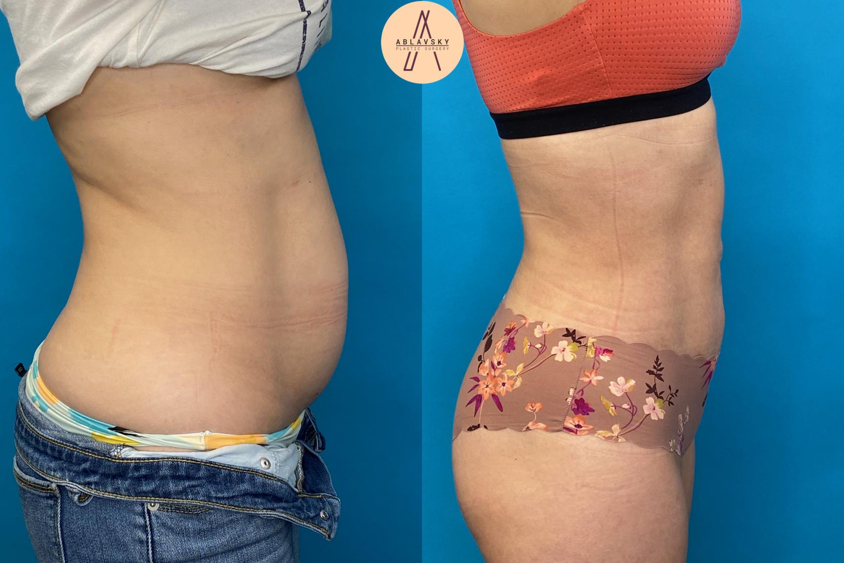 Before & After Liposuction Case 21 Right Side View in San Antonio, Texas
