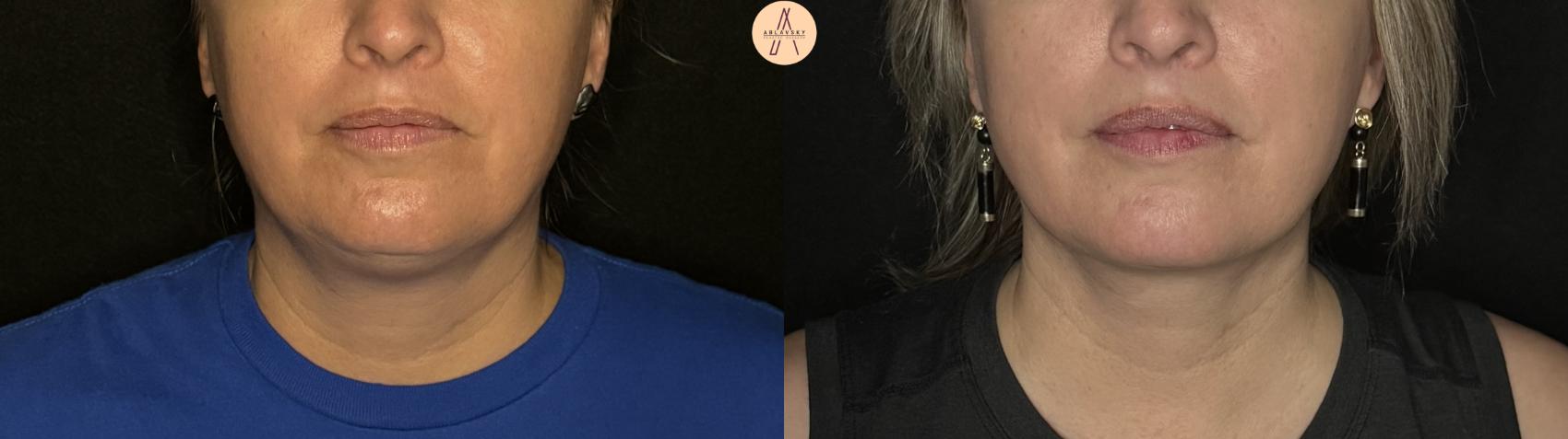 Before & After Liposuction Case 296 Front View in San Antonio, Texas