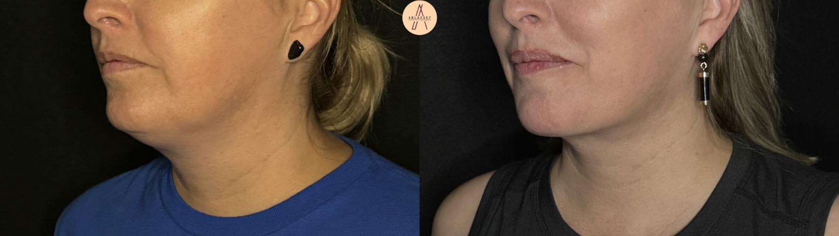 Before & After Liposuction Case 296 Left Oblique View in San Antonio, Texas