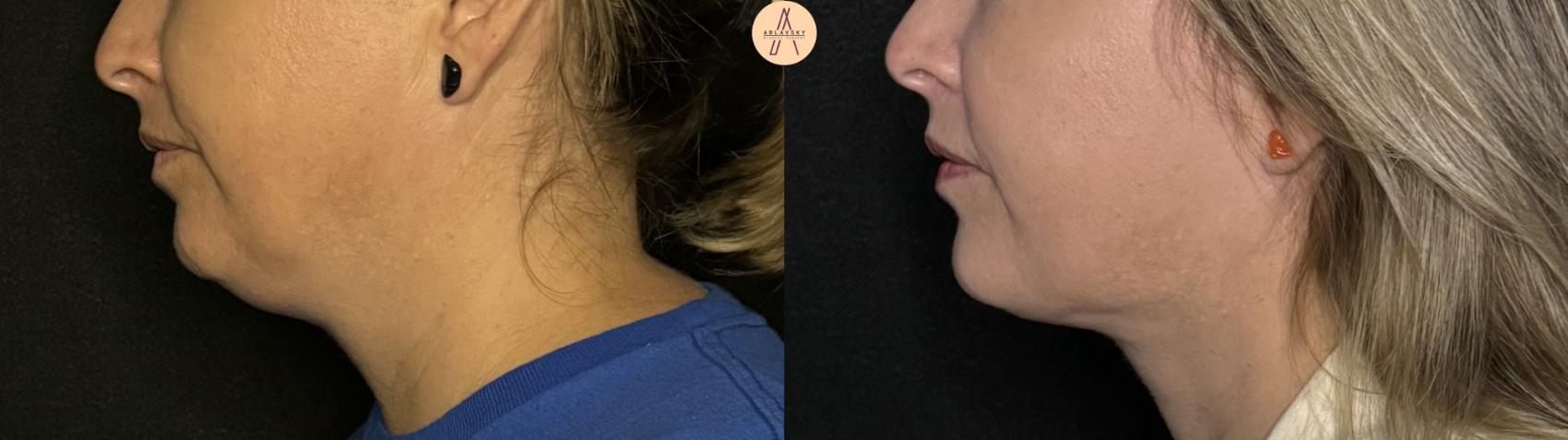 Before & After Liposuction Case 296 Left Side View in San Antonio, Texas