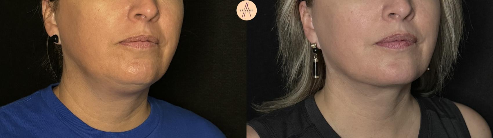 Before & After Liposuction Case 296 Right Oblique View in San Antonio, Texas