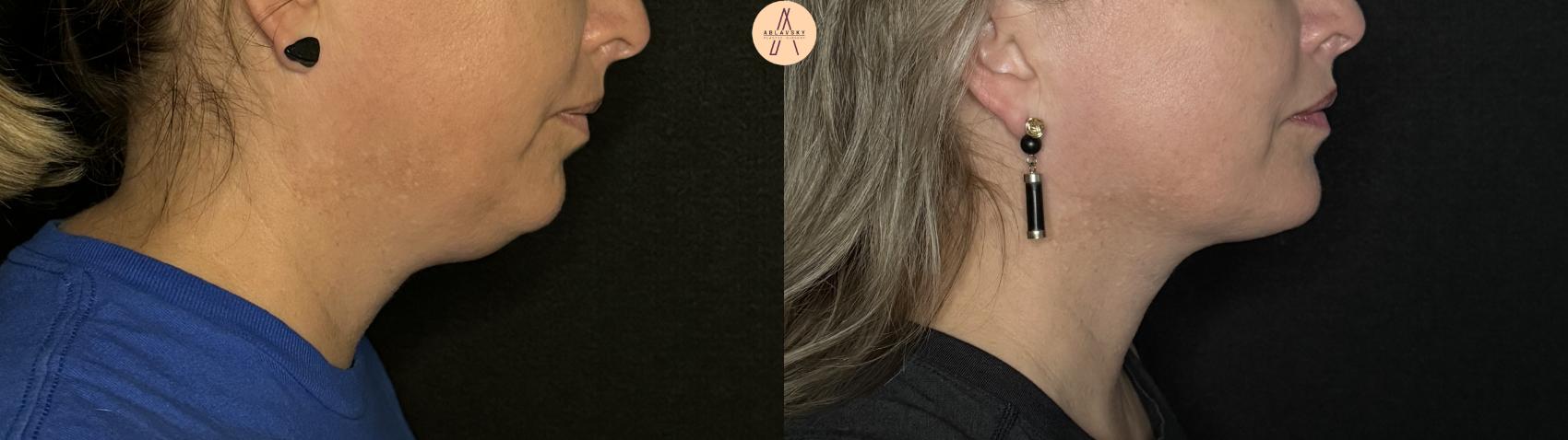 Before & After Liposuction Case 296 Right Side View in San Antonio, Texas