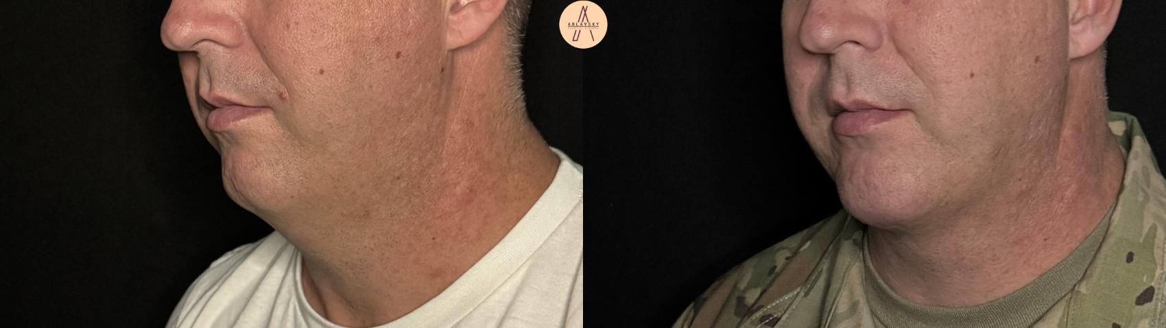 Before & After Liposuction Case 316 Left Oblique View in San Antonio, Texas