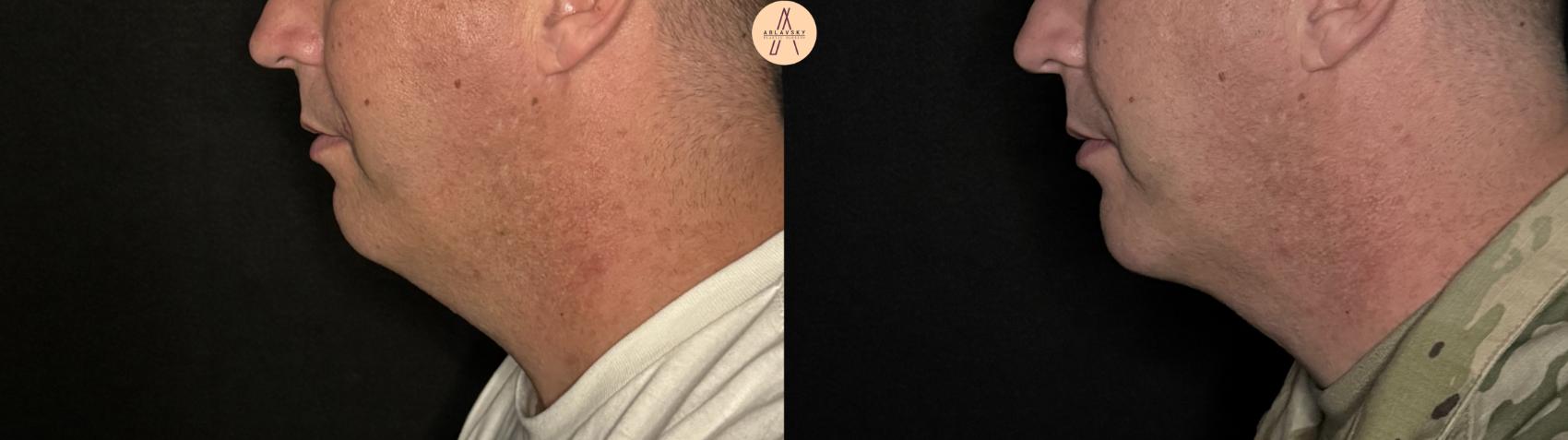 Before & After Liposuction Case 316 Left Side View in San Antonio, Texas