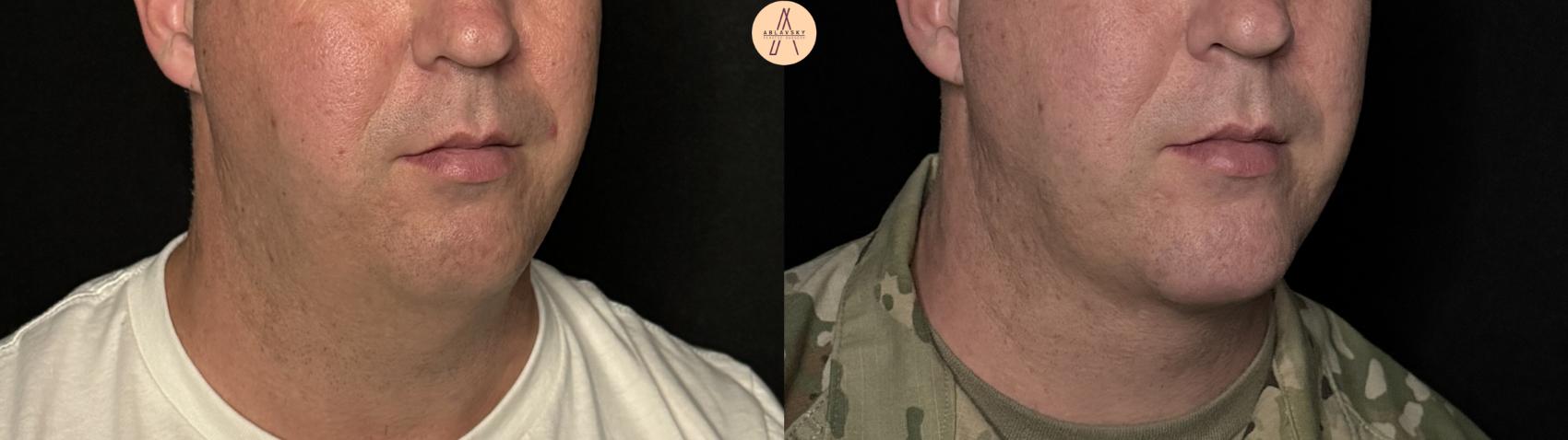 Before & After Liposuction Case 316 Right Oblique View in San Antonio, Texas
