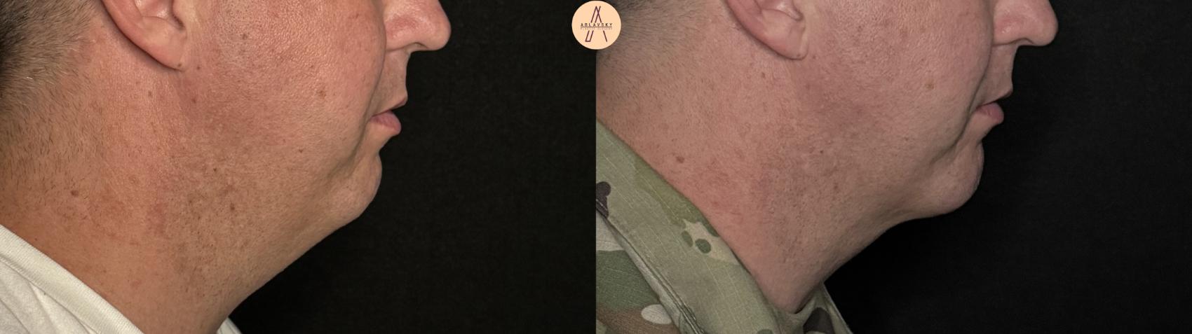 Before & After Liposuction Case 316 Right Side View in San Antonio, Texas