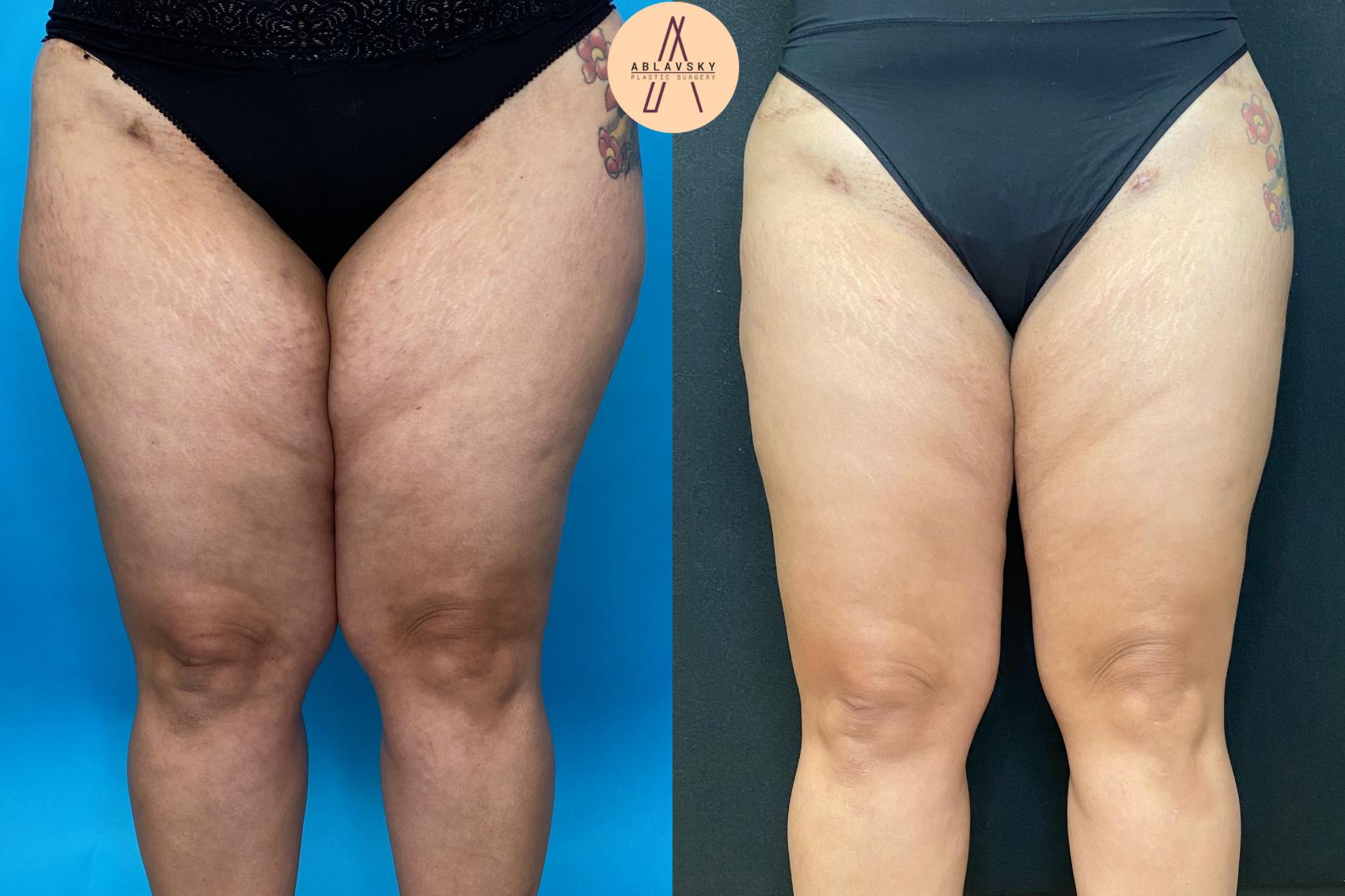 Before & After Liposuction Case 34 Front View in San Antonio, Texas