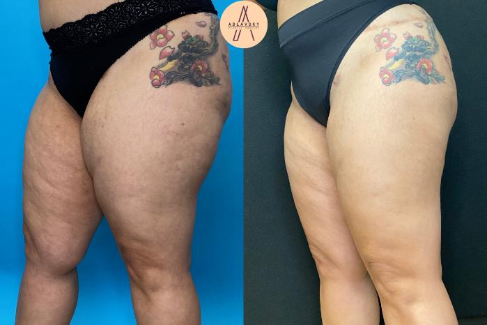 Before & After Liposuction Case 34 Left Oblique View in San Antonio, Texas
