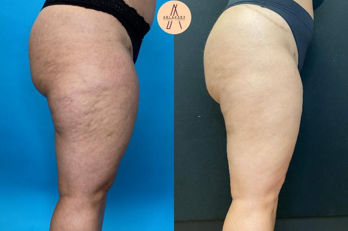 Before & After Liposuction Case 34 Right Side View in San Antonio, Texas
