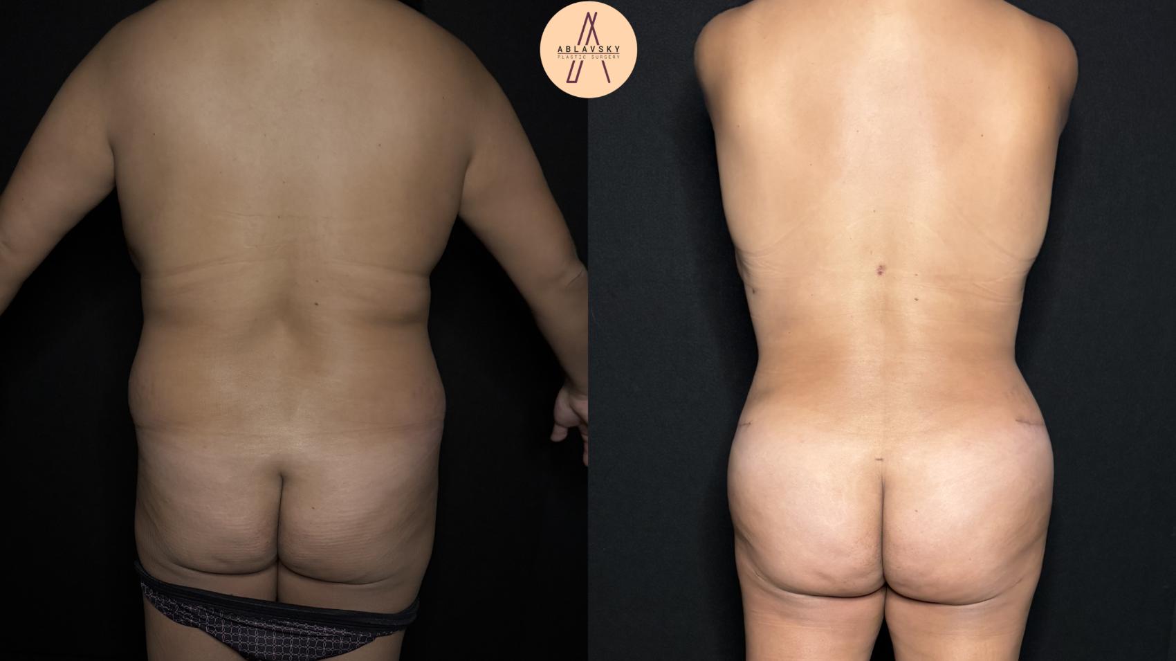 Before & After Tummy Tuck Case 346 Back View in San Antonio, Texas