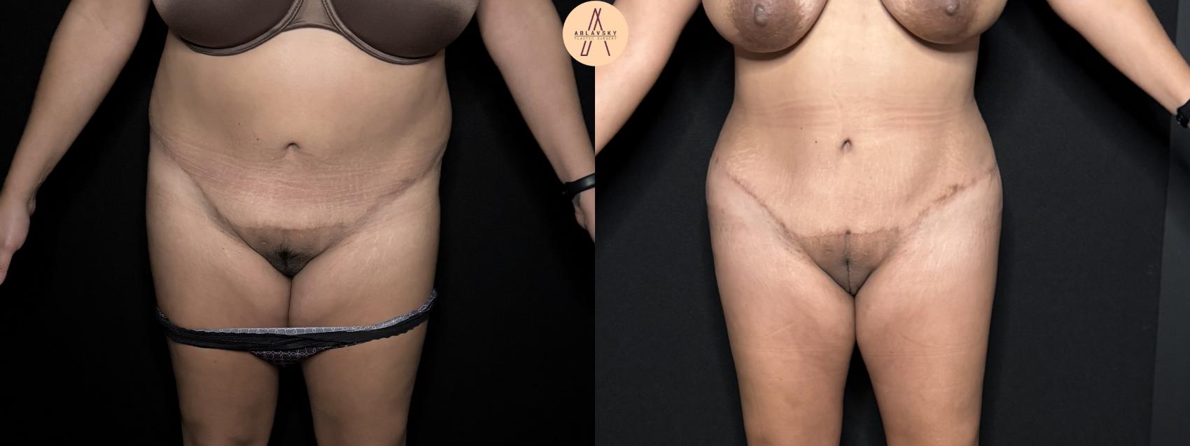 Before & After Tummy Tuck Case 346 Front View in San Antonio, Texas