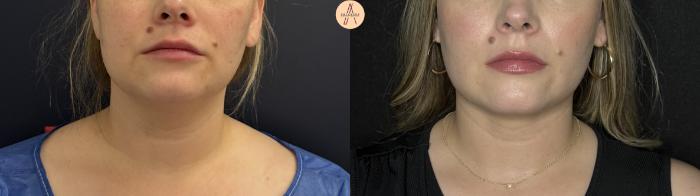 Before & After Liposuction Case 360 Front View in San Antonio, Texas