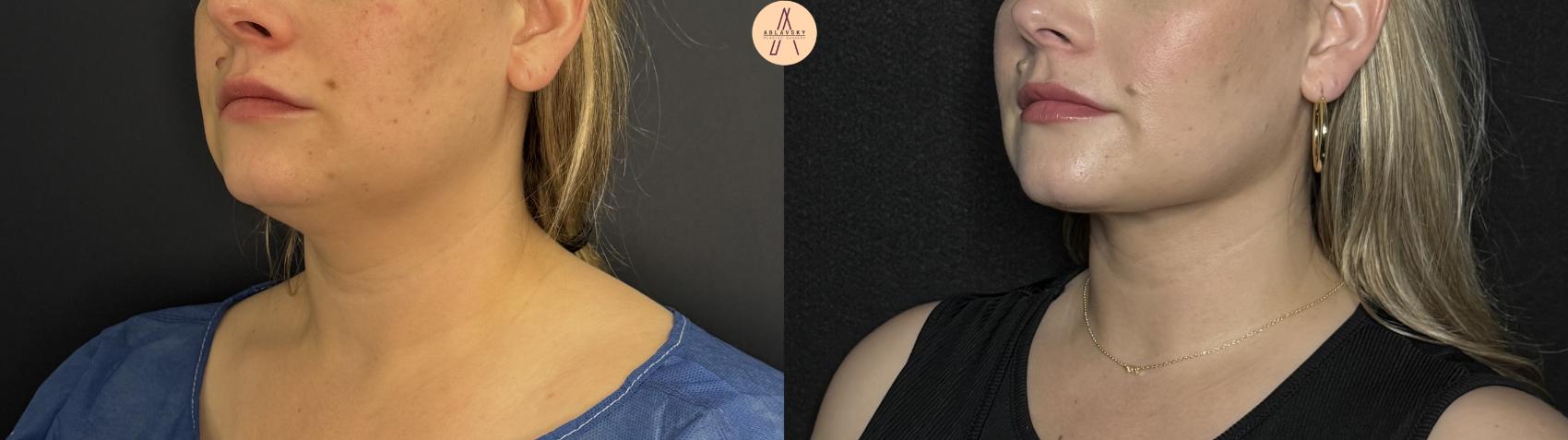 Before & After Submental Liposuction Case 360 Left Oblique View in San Antonio, Texas