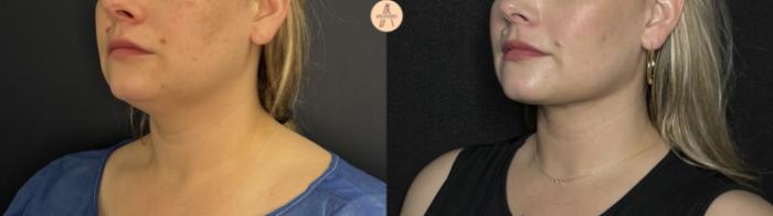 Before & After Liposuction Case 360 Left Oblique View in San Antonio, Texas