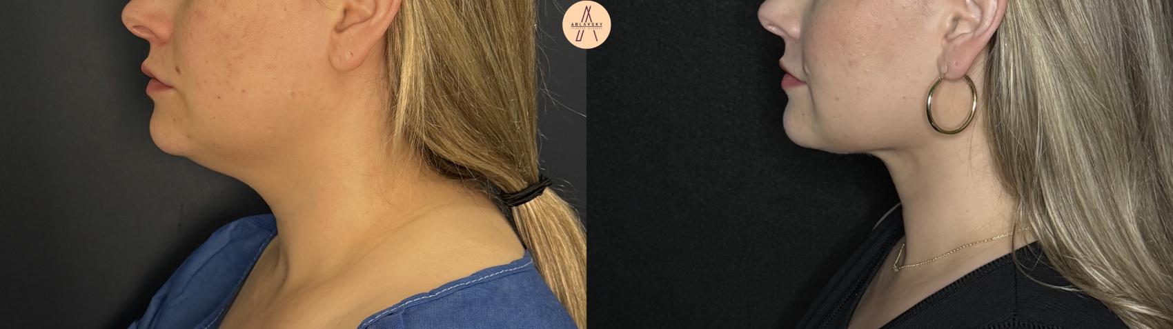 Before & After Submental Liposuction Case 360 Left Side View in San Antonio, Texas