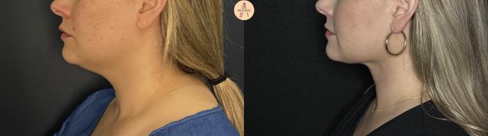 Before & After Liposuction Case 360 Left Side View in San Antonio, Texas