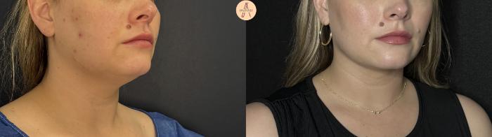 Before & After Liposuction Case 360 Right Oblique View in San Antonio, Texas