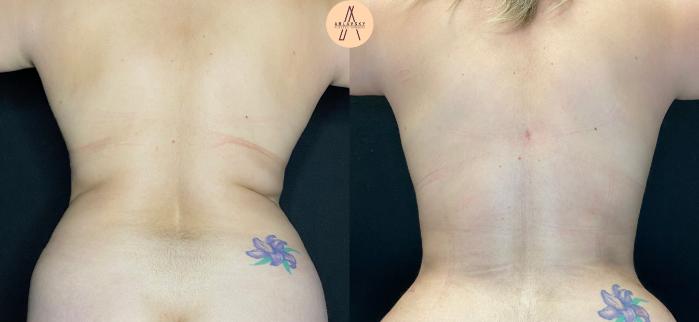 Before & After Liposuction Case 39 Back View in San Antonio, Texas