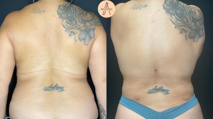 Before & After Liposuction Case 46 Back View in San Antonio, Texas