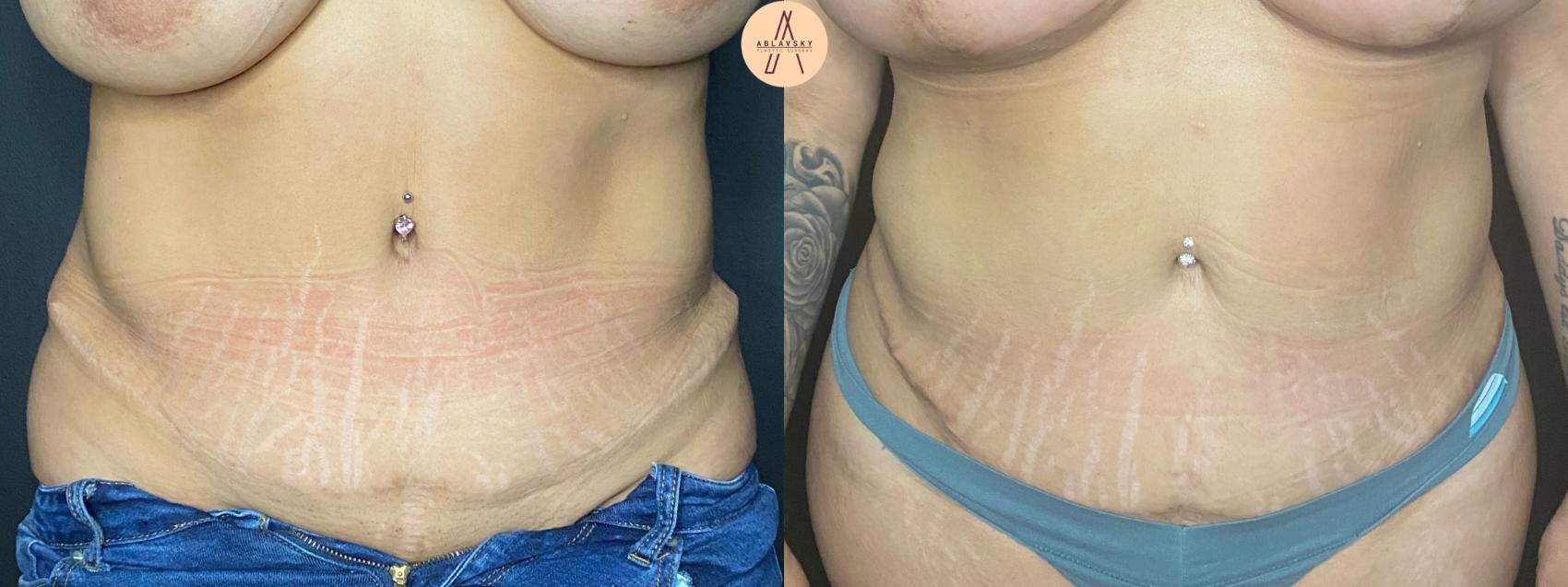 Before & After Liposuction Case 46 Front View in San Antonio, Texas